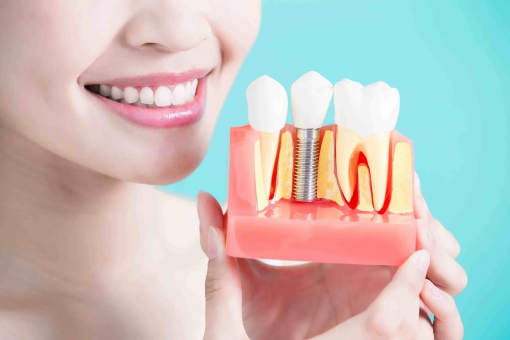 Dental implant 1024x683